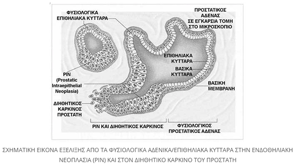 anaptiksi karkinou prostati