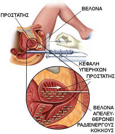brachytherapy