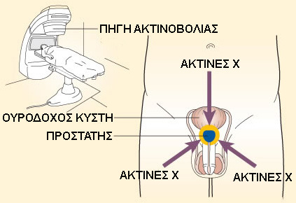 ex radiation