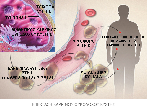 poreia karkinou ourodoxou kistis