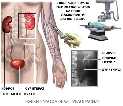 prosimptomatiki diagnosi prostati 3