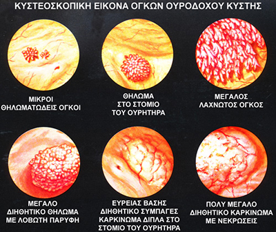 prosimptomatiki diagnosi prostati 4