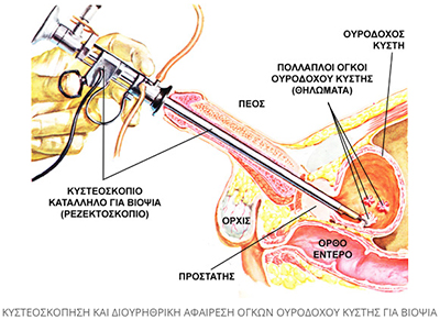 prosimptomatiki diagnosi prostati 5