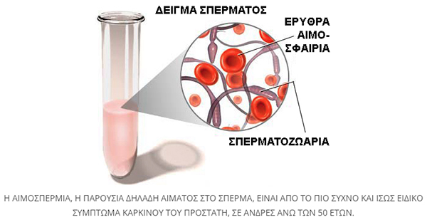 simptomata karkinou prostati 1