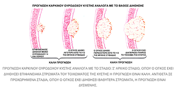 stadia karkinou ourodoxou kistis 1