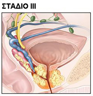 stage iii