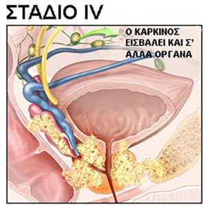 stage iv