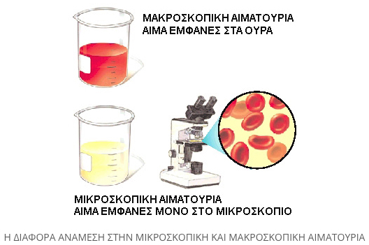 symptomata karkinou ourodoxou kistis 1