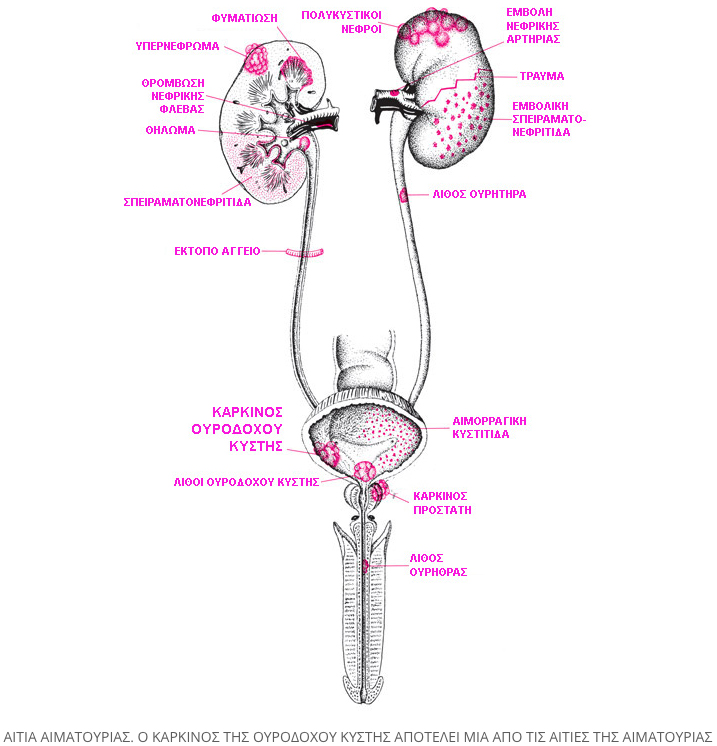 symptomata karkinou ourodoxou kistis 2