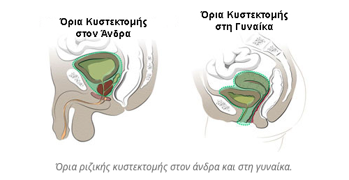 kistektomi