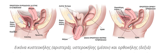 kysteokili ysterokili orthokili