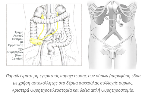 ouritirostomia