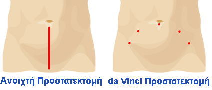 prostatectomyincisioncomparison