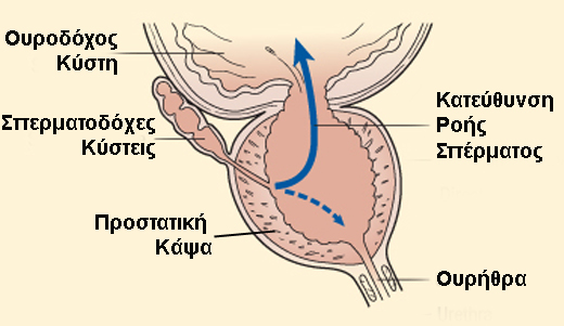 retrograde ejaculation