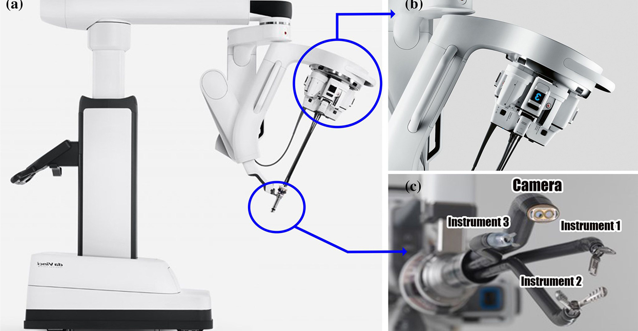  Da Vinci SP - DVP following bilateral TEP laparoscopic inguinal hernia repair with mesh